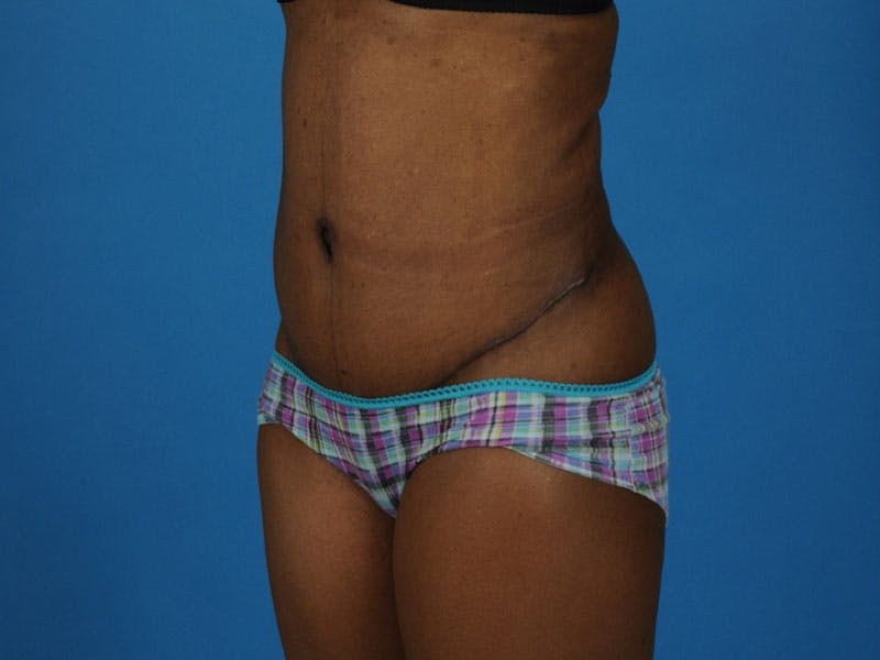 Tummy Tuck Before & After Gallery - Patient 217166 - Image 4