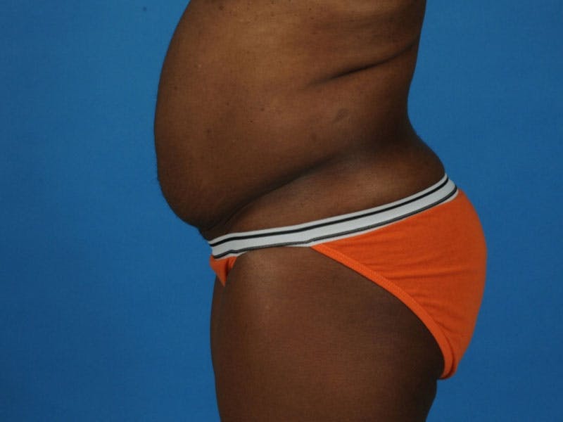 Tummy Tuck Before & After Gallery - Patient 217166 - Image 5