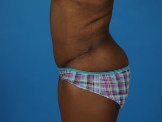 Tummy Tuck Before & After Gallery - Patient 217166 - Image 6