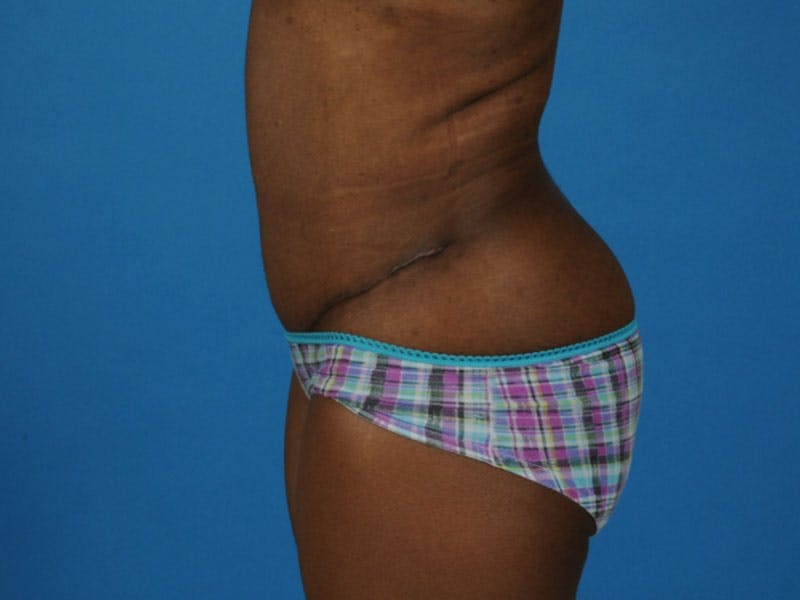 Tummy Tuck Before & After Gallery - Patient 217166 - Image 6