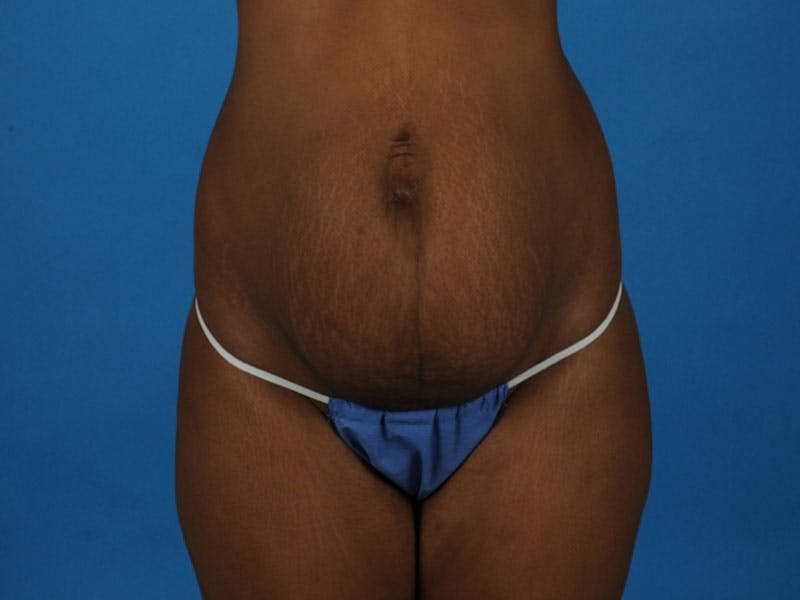 Tummy Tuck Before & After Gallery - Patient 421125 - Image 1