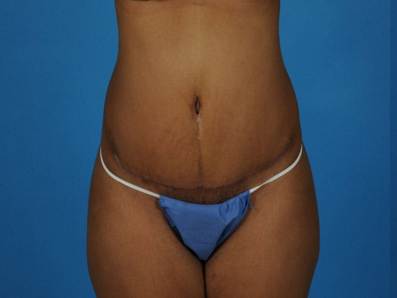Tummy Tuck Before & After Gallery - Patient 421125 - Image 2