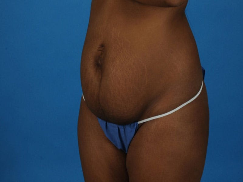 Tummy Tuck Before & After Gallery - Patient 421125 - Image 3