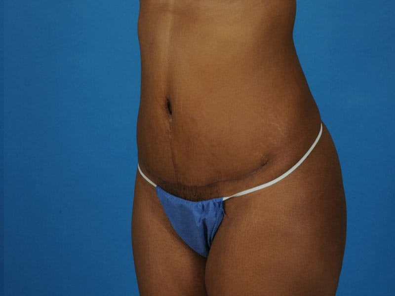 Tummy Tuck Before & After Gallery - Patient 421125 - Image 4