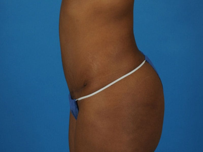 Tummy Tuck Before & After Gallery - Patient 421125 - Image 6