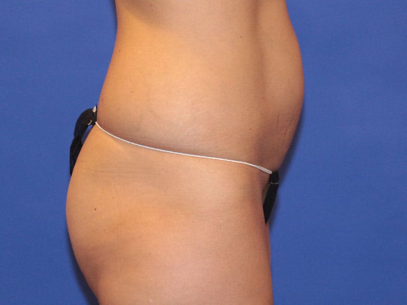 Tummy Tuck Before & After Gallery - Patient 196718 - Image 1