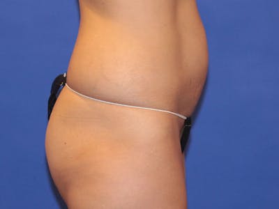 Tummy Tuck Before & After Gallery - Patient 196718 - Image 1