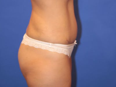Tummy Tuck Before & After Gallery - Patient 196718 - Image 2