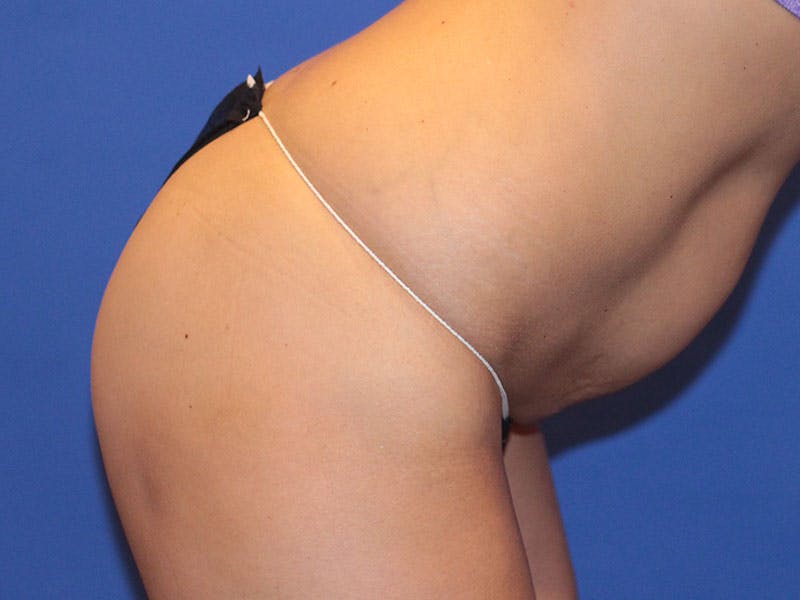 Tummy Tuck Before & After Gallery - Patient 196718 - Image 3