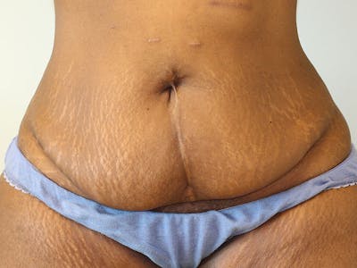 Tummy Tuck Before & After Gallery - Patient 284348 - Image 1