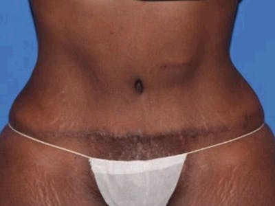 Tummy Tuck Before & After Gallery - Patient 284348 - Image 2