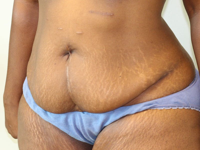 Tummy Tuck Before & After Gallery - Patient 284348 - Image 3