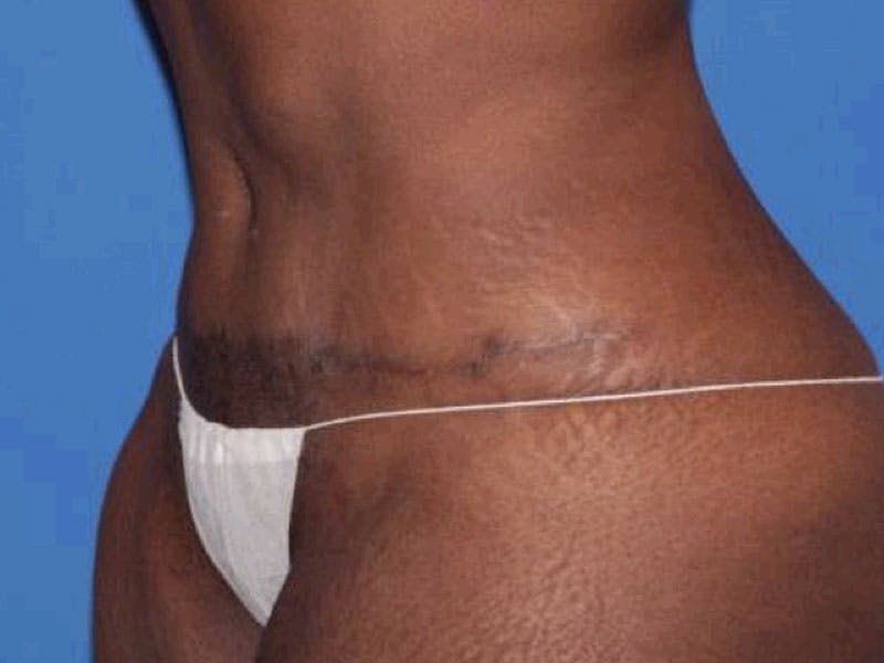 Tummy Tuck Before & After Gallery - Patient 284348 - Image 4