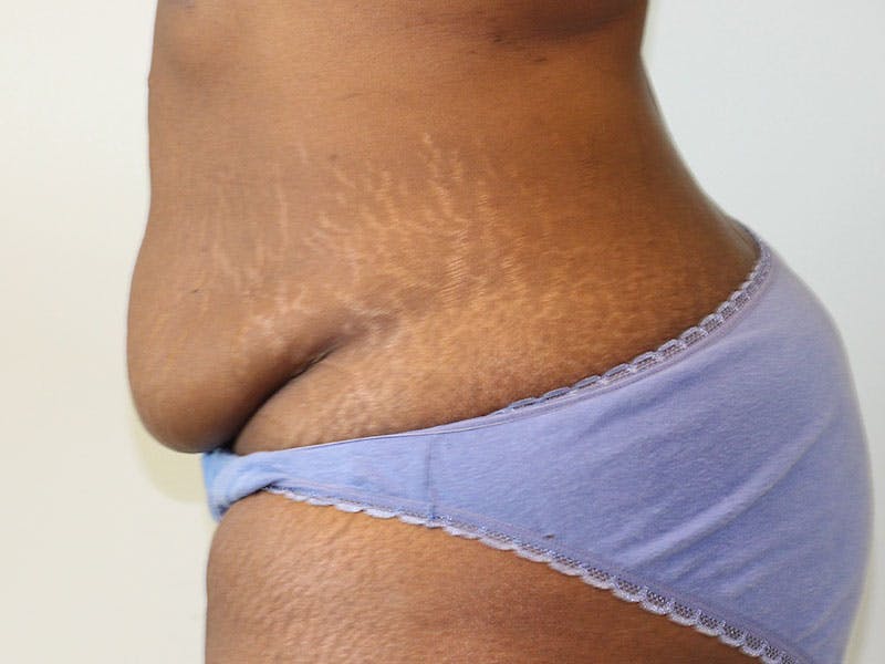 Tummy Tuck Before & After Gallery - Patient 284348 - Image 5