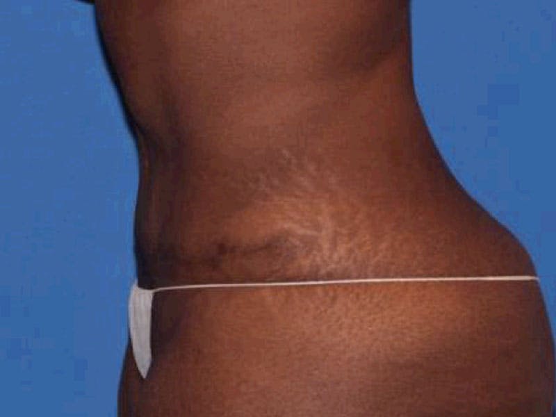 Tummy Tuck Before & After Gallery - Patient 284348 - Image 6