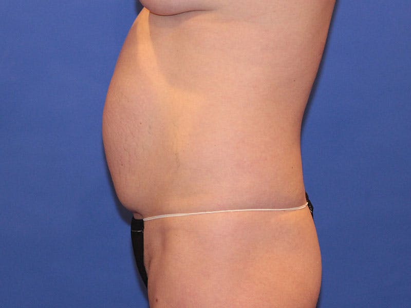 Tummy Tuck Before & After Gallery - Patient 589649 - Image 1
