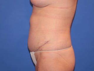 Tummy Tuck Before & After Gallery - Patient 589649 - Image 2