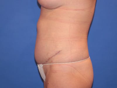 Tummy Tuck Before & After Gallery - Patient 589649 - Image 2