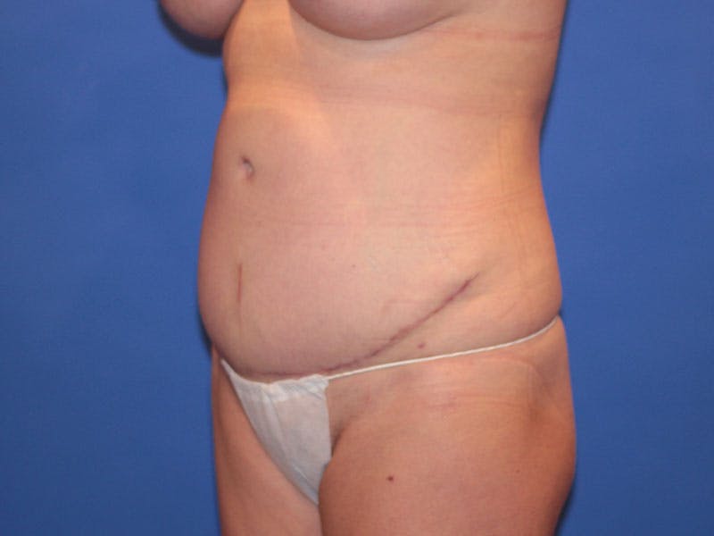 Tummy Tuck Before & After Gallery - Patient 589649 - Image 4