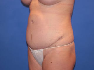 Tummy Tuck Before & After Gallery - Patient 589649 - Image 4