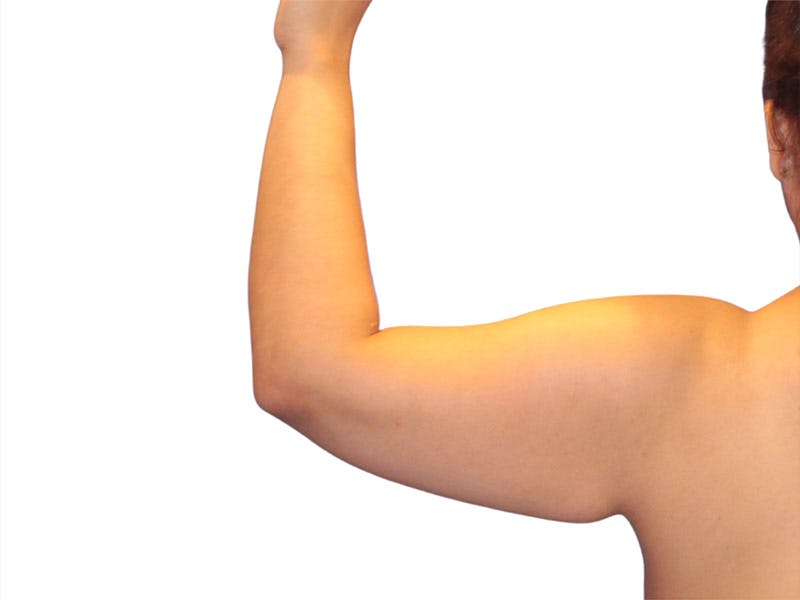 Brachioplasty Before & After Gallery - Patient 354836 - Image 1