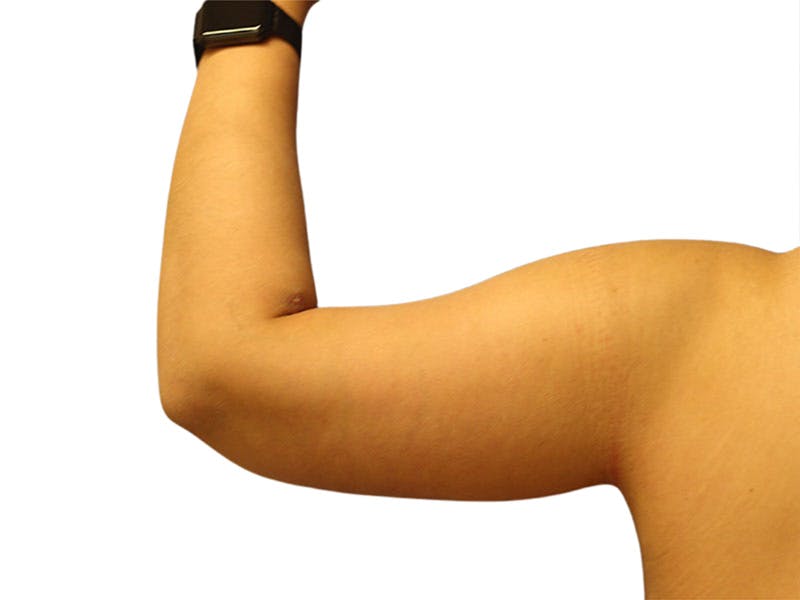 Brachioplasty Before & After Gallery - Patient 354836 - Image 2