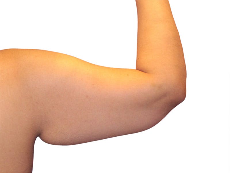 Brachioplasty Before & After Gallery - Patient 354836 - Image 3