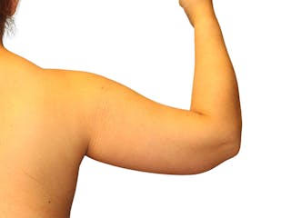 Brachioplasty Before & After Gallery - Patient 354836 - Image 4