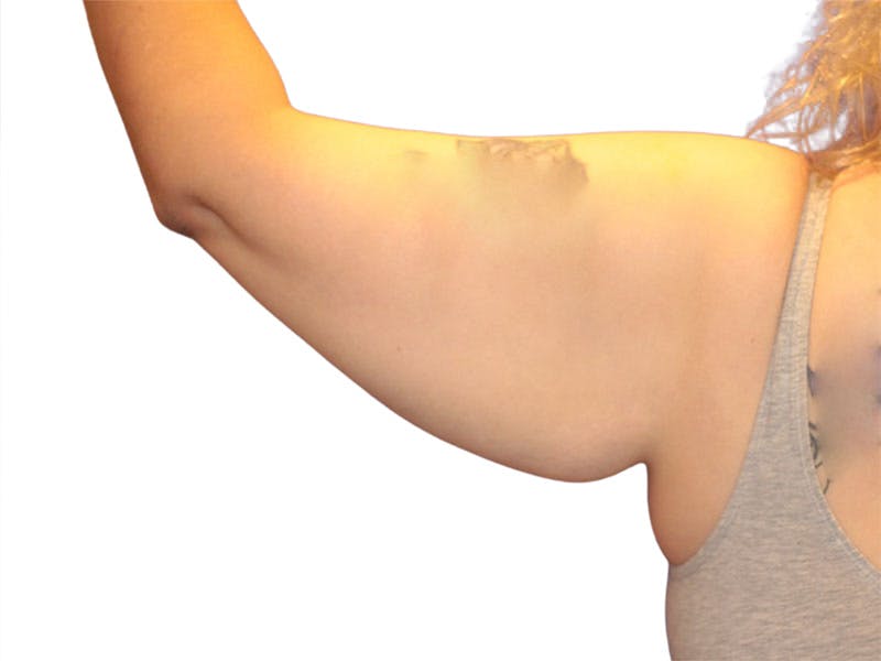Brachioplasty Before & After Gallery - Patient 111552 - Image 1