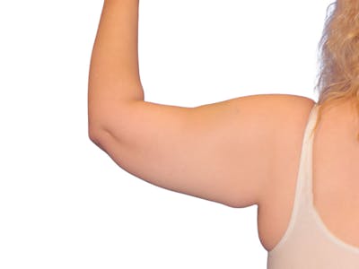 Brachioplasty Before & After Gallery - Patient 111552 - Image 2