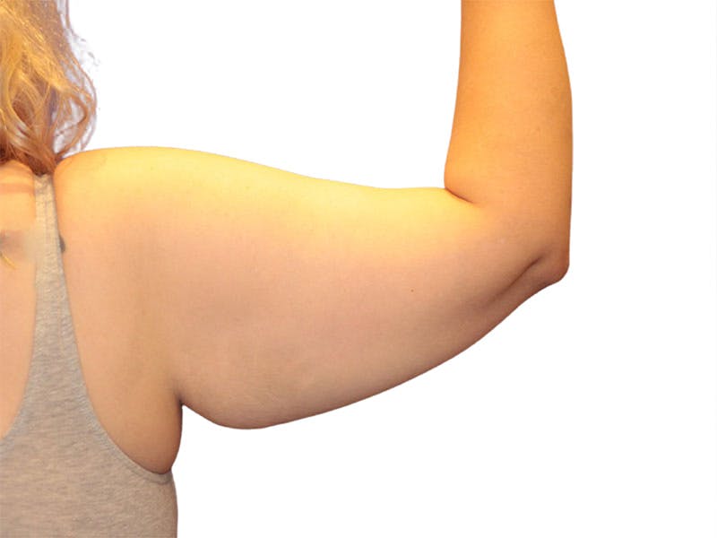 Brachioplasty Before & After Gallery - Patient 111552 - Image 3
