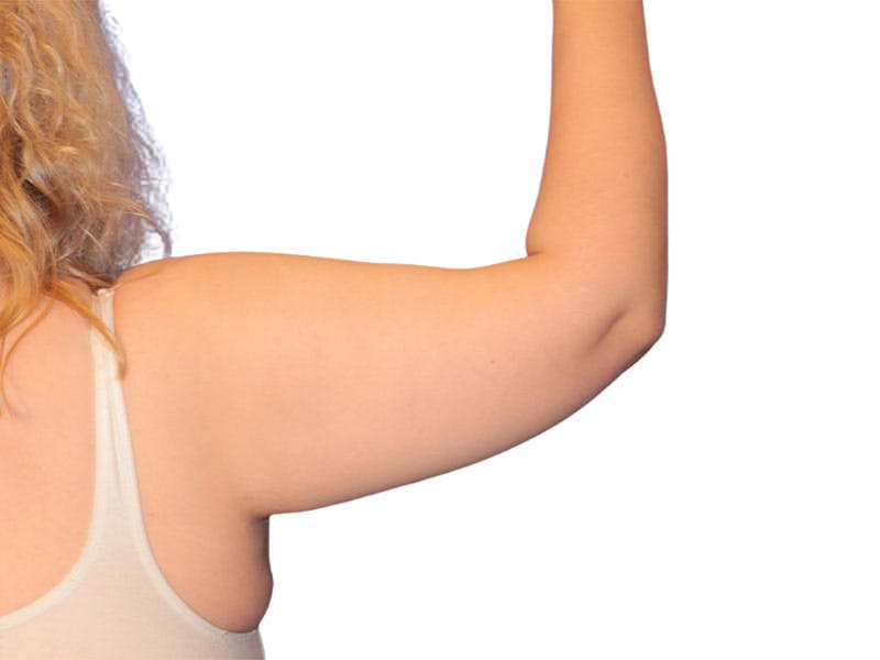 Brachioplasty Before & After Gallery - Patient 111552 - Image 4