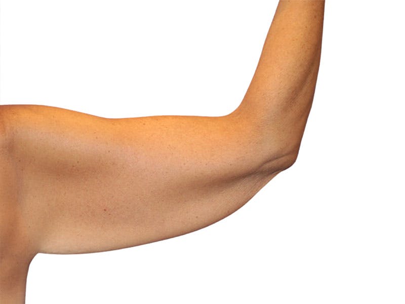 Brachioplasty Before & After Gallery - Patient 401954 - Image 1