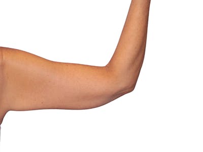 Brachioplasty Before & After Gallery - Patient 401954 - Image 2