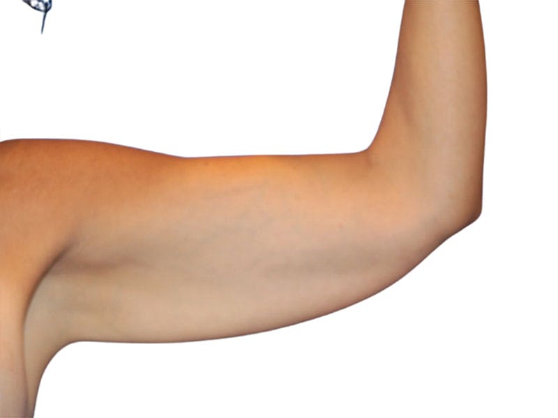 Brachioplasty Before & After Gallery - Patient 401954 - Image 3