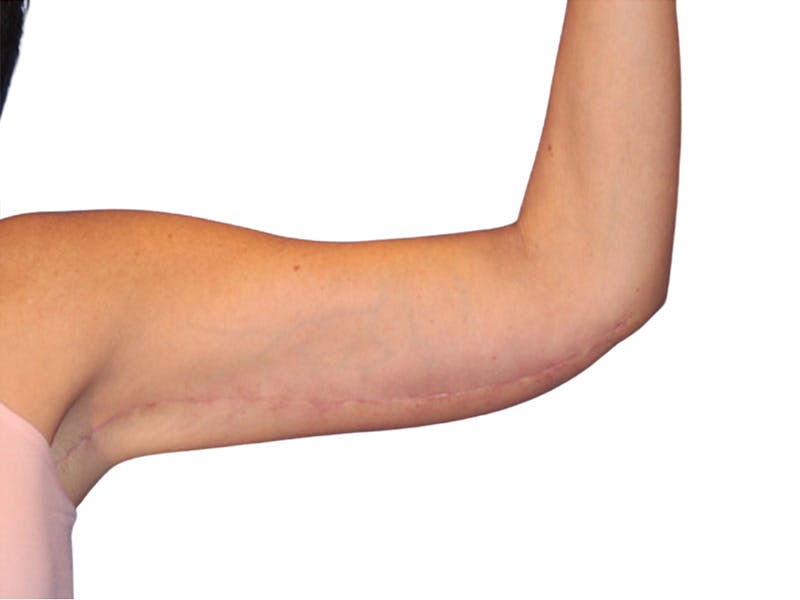 Brachioplasty Before & After Gallery - Patient 401954 - Image 4