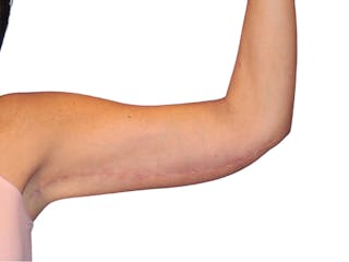 Brachioplasty Before & After Gallery - Patient 401954 - Image 4