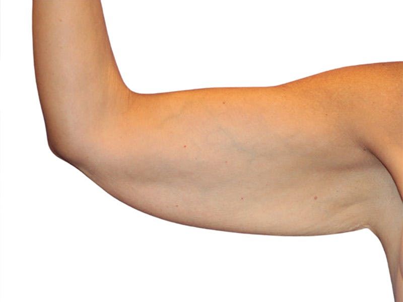 Brachioplasty Before & After Gallery - Patient 401954 - Image 5