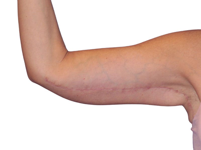 Brachioplasty Before & After Gallery - Patient 401954 - Image 6