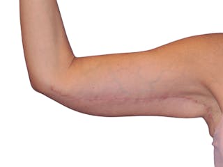 Brachioplasty Before & After Gallery - Patient 401954 - Image 6