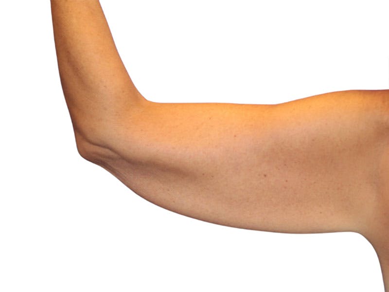 Brachioplasty Before & After Gallery - Patient 401954 - Image 7