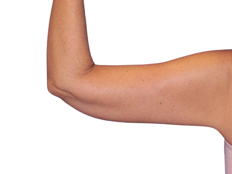 Brachioplasty Before & After Gallery - Patient 401954 - Image 8