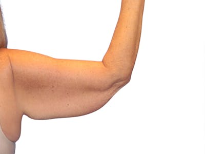 Brachioplasty Before & After Gallery - Patient 409793 - Image 1