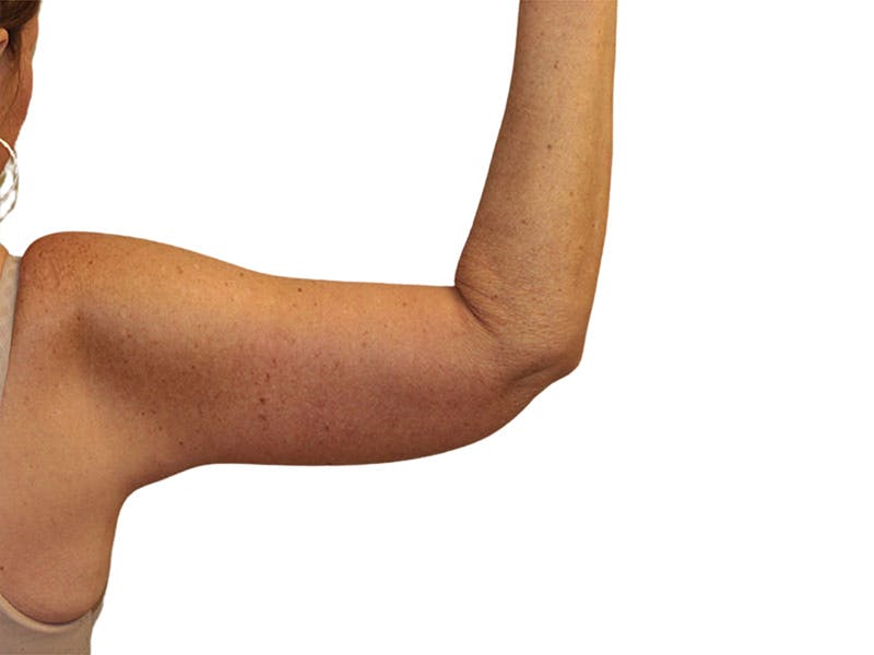 Brachioplasty Before & After Gallery - Patient 409793 - Image 2