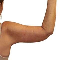 Brachioplasty Before & After Gallery - Patient 409793 - Image 2