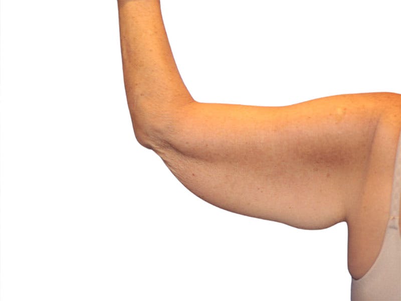 Brachioplasty Before & After Gallery - Patient 409793 - Image 3