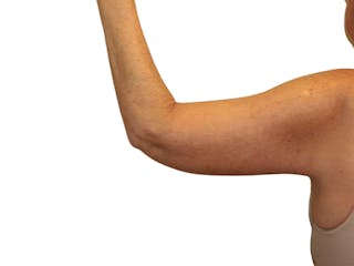 Brachioplasty Before & After Gallery - Patient 409793 - Image 4