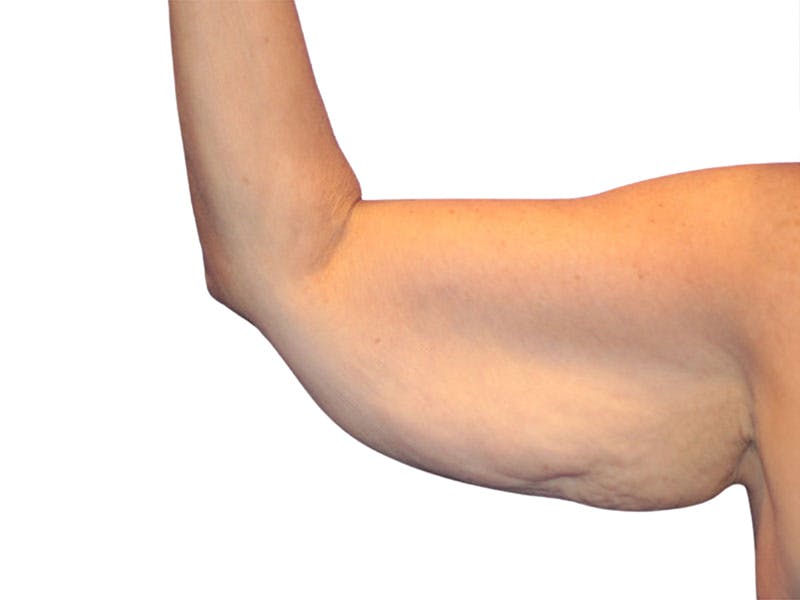 Brachioplasty Before & After Gallery - Patient 409793 - Image 5
