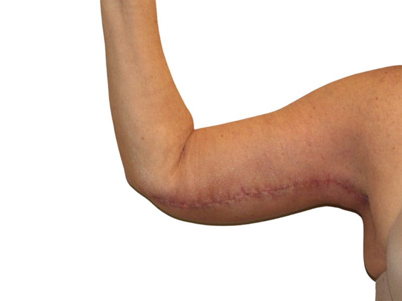 Brachioplasty Before & After Gallery - Patient 409793 - Image 6