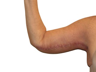 Brachioplasty Before & After Gallery - Patient 409793 - Image 6